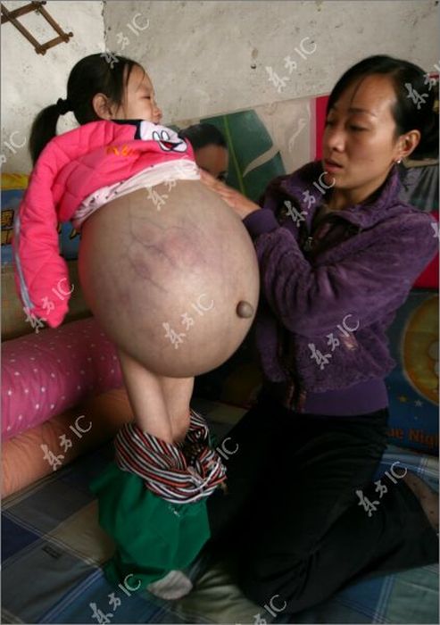 4-Year-Old Girl with Giant Abdomen (19 pics)