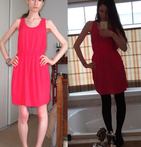 This Woman Is Looking Great After Recovering From An Eating Disorder (3 pics)